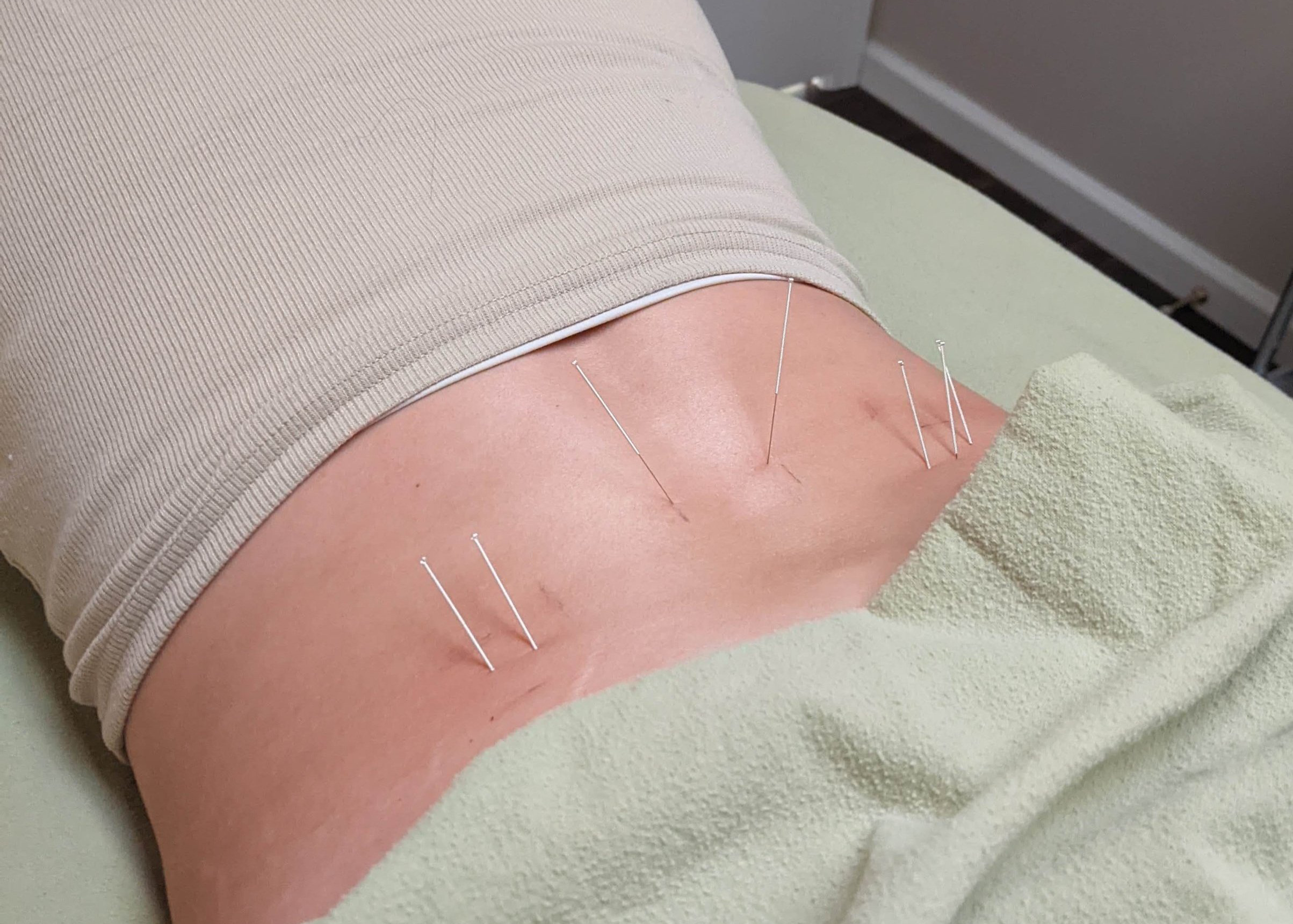 dry+needling+pelvic